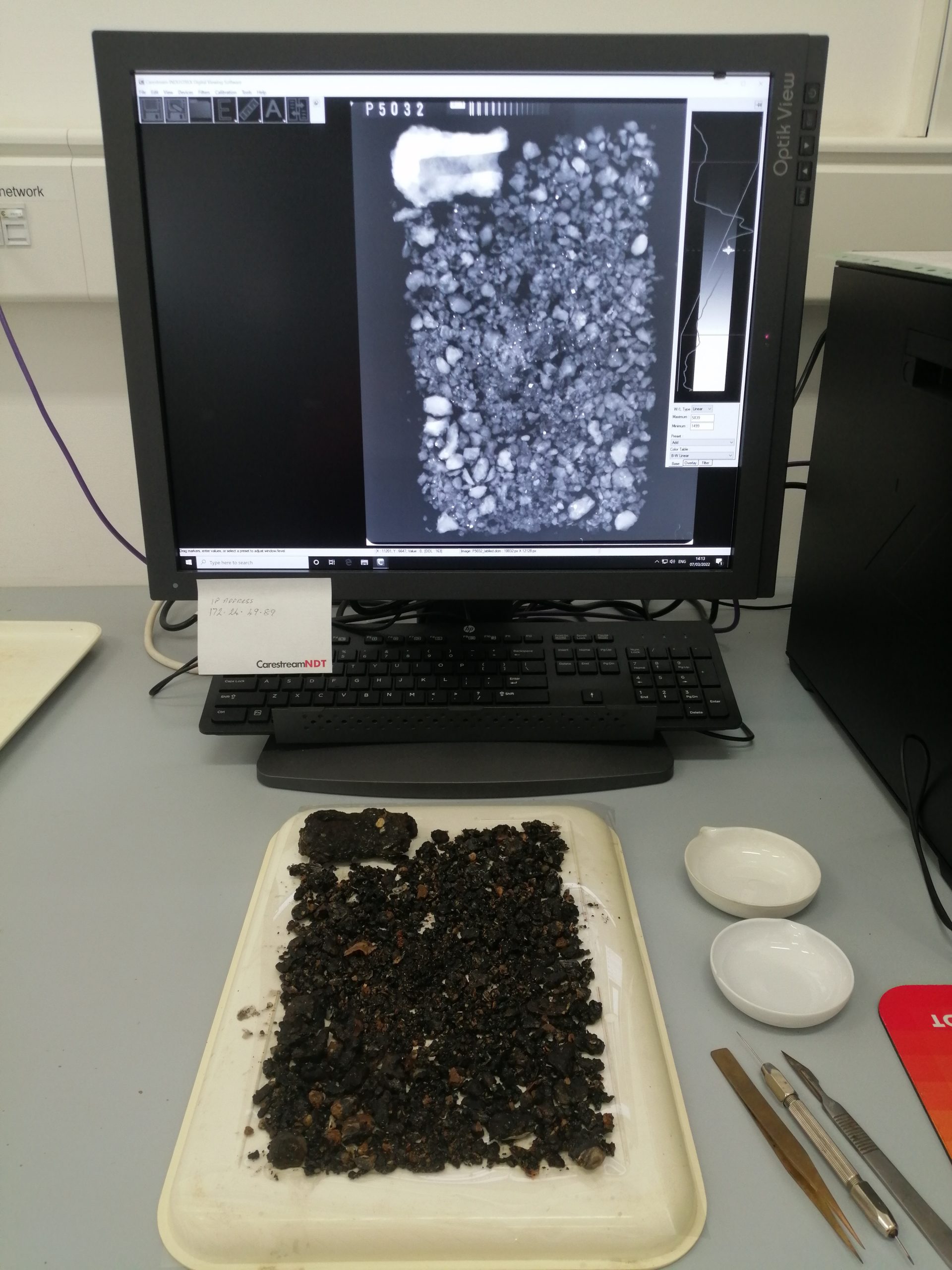 X-ray of concretion debris enabling further retrieval of small objects.
